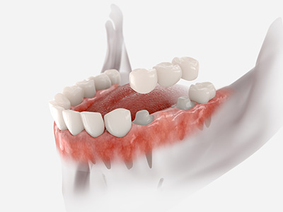 A 3D rendering of an open mouth with teeth showing, displaying a red substance inside.