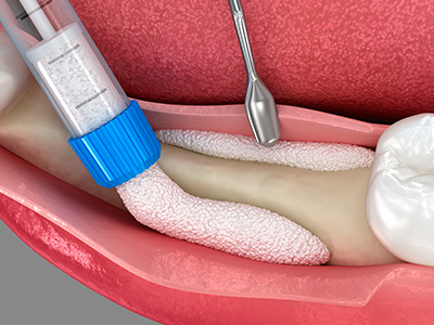 An illustration showing a close-up view of a medical procedure involving a tooth with a dental implant screwed into it, with a syringe filled with bone graft material being injected into the socket for treatment.