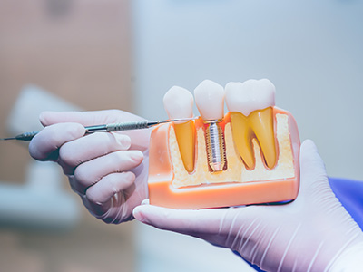 A person s hand holding an open mouth model with visible teeth and dental implants, against a blurred background.