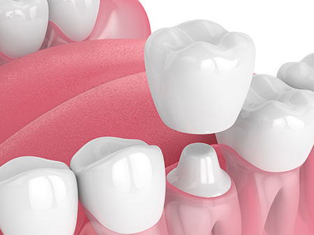 The image features a close-up view of a collection of artificial teeth with various shades of pink and white, arranged on a dental implant base against a white background.