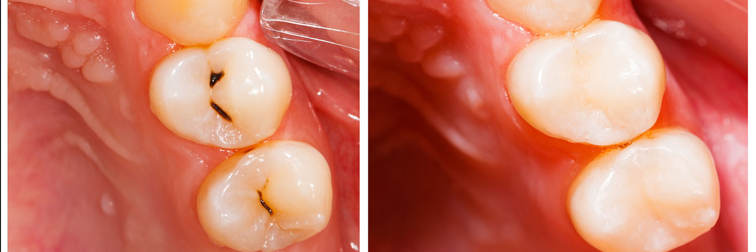 The image shows a close-up view of a person s mouth with several teeth showing signs of decay and damage, including cavities and broken edges, against a blurred background that appears to be a medical setting.