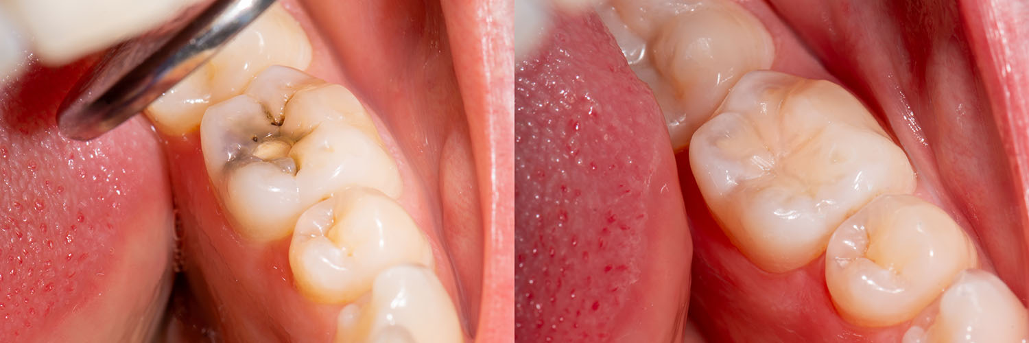 The image displays a close-up view of a tooth with dental work being performed, showcasing drilling and possibly other tools used for dental procedures.