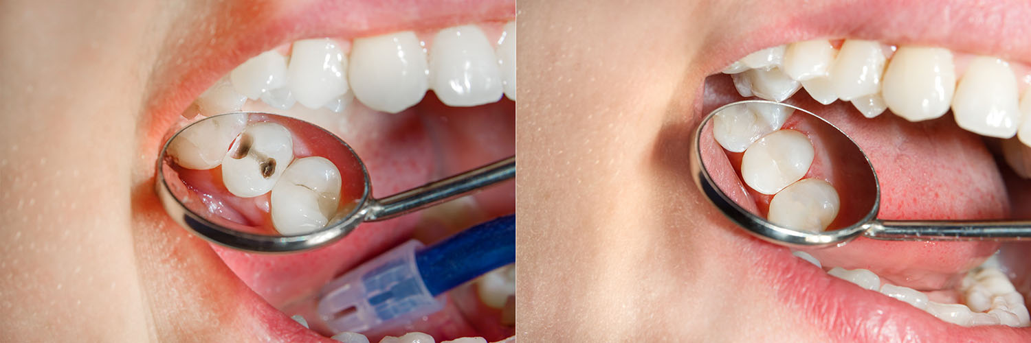 The image shows two photographs of a person s open mouth with a dental mirror inside, revealing teeth and gums, with an  alt  tag describing the content for accessibility purposes.