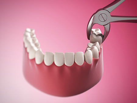 The image shows a close-up of a red dental implant being inserted into a mouth with a pair of pliers, highlighting a dental procedure in progress.