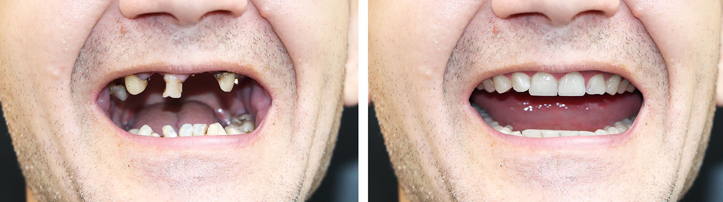 The image shows a split-screen comparison of an individual s smiling face with their mouth open on the left side, and their teeth and mouth in close-up detail on the right side.