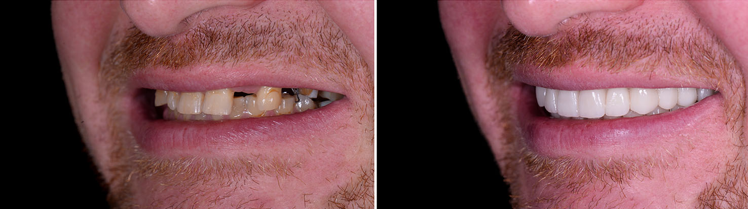 The image shows a split-screen comparison of a person s teeth before and after dental work, with a focus on the dramatic difference in appearance between the two sides.